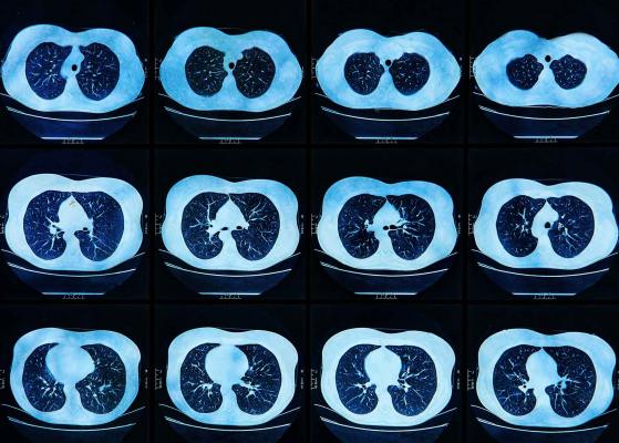 The Moscow Center for Diagnostics and Telemedicine presented clinical research findings during ECR 2021 highlighting that full integration of AI into radiology workflow during the pandemic increased radiologists' productivity