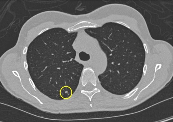 A recent, substantial decline in lung cancer deaths is associated with earlier diagnosis of lung cancer than in the past, supporting the need for increased use of screening to save lives, according to a Mount Sinai study published in JAMA Network Open in December.