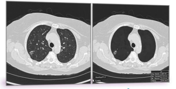 Researchers Use Radiomics to Overcome False Positives in Lung Cancer CT Screening
