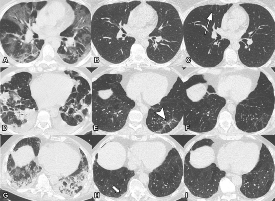 Serial non-contrast axial chest CTs of three study participants with prior COVID-19 pneumonia. 