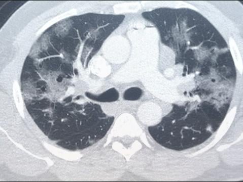 An example of a COVID-19 pneumonia of a chest CT scan. The COVID appears as white ground glass opacities (GGOs) in the lungs. Normal lungs on CT should appear black.