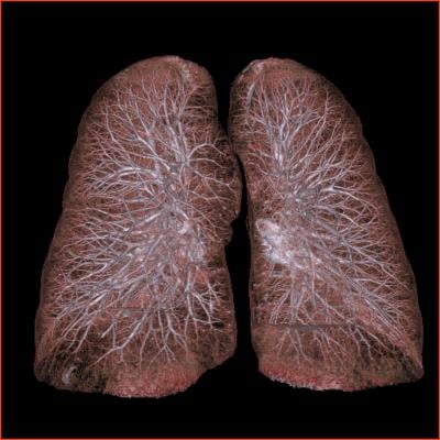 MD Anderson Study Early-stage Lung Cancer