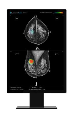 Collaborative study with the University of Nottingham Published in Radiology Highlights Potential of AI in Breast Cancer Detection