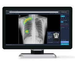 The software will be embedded in Agfa’s MUSICA Workstation, which provides radiographers an intuitive interface and recognized among radiologist community as excellent image quality. 