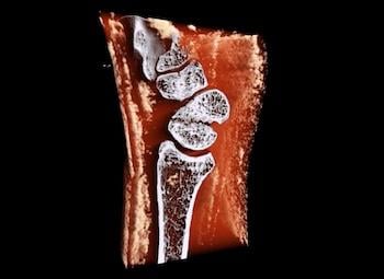 MARS Bioimaging wrist