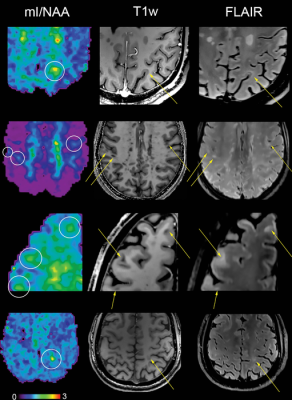 Metabolic maps showing the ratio of myo-inositol to N-acetylaspartate (mI/NAA) clearly depict small subcortical or juxtacortical lesions (circles) that appear inconspicuous at T1-weighted MRI (T1w)/fluid-attenuated inversion-recovery (FLAIR) imaging (indicated with arrows in three participants with multiple sclerosis). Image courtesy of Radiological Society of North America
