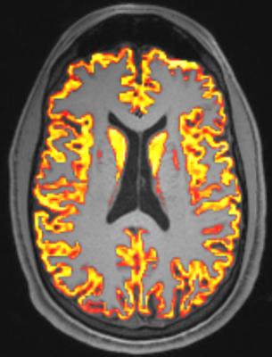 Diffusion microstructure imaging, a novel MRI technique, can provide detailed information about brain tissues