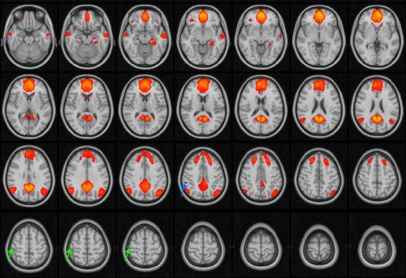 Figure 1. MRI images of the brain, with the default mode network (DMN) highlighted in orange/red. The DMN is active during periods of wakeful rest, when the mind is not focused on a particular task. The green and blue arrows point to areas of the network that are disrupted in adolescent patients with concussions.