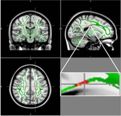 Reduction in fractional anisotropy (FA) in obese patients compared to the control group