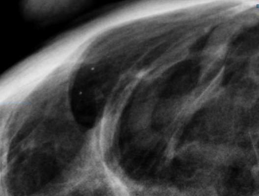 FDA Proposes New Rules for Mammography Reporting and Quality Improvement