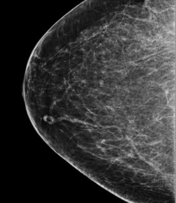 Women 75-plus May Not Benefit from Breast Cancer Screening