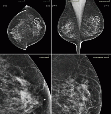 Mammograms in a 51-year-old woman with invasive ductal carcinoma. The upper panels show the craniocaudal and the mediolateral oblique views. The lower panels show a close-up of the left breast area containing the lesion. The case is one of the false-negative cases included in the dataset. Accordingly, the initial screening assessment was a BI-RADS 2, meaning visible findings were judged as benign. After 1 year, the patient presented for another screening examination. This time, a focal asymmetry with associ