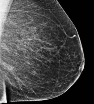Bielefeld University Germany study, mammography screening, informed decisions