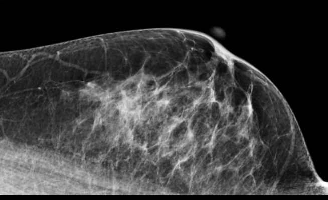mammography, comparison, prior examinations, UCSF study, American Journal of Roentgenology