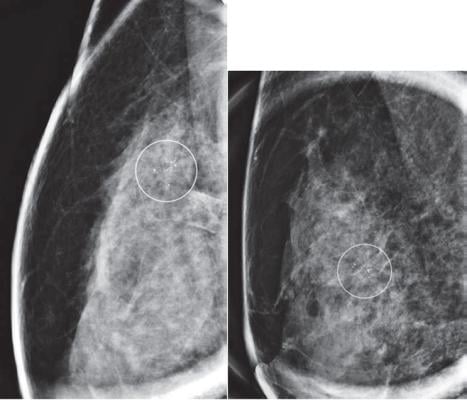 40-year-old woman with calcifications detected on baseline screening mammography