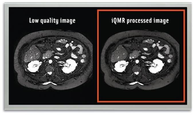 Medic Vision Wins Japanese PMDA Clearance for iQMR Image Reconstruction Solution