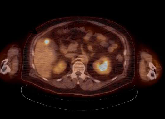Proton Therapy Radiation X-Ray Liver Metastases