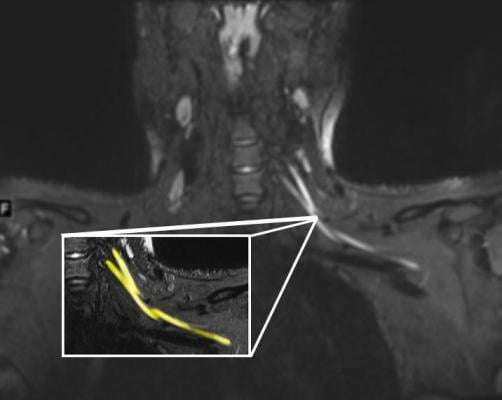 An MR image of a patient in their early 20s shows nerve injury (highlighted in yellow) of the left brachial plexus in the neck. The patient experienced left arm weakness and pain after recovering from COVID-19 respiratory illness, which prompted them to see their primary care physician. As a result of the MRI findings, the patient was referred to the COVID-19 neurology clinic for treatment. Image courtesy of Northwestern University