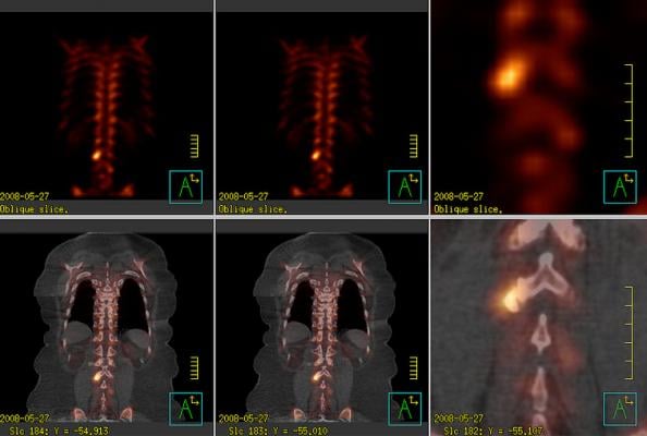Nuclear imaging of the spine shown on Philips Healthcare BrightView XCT