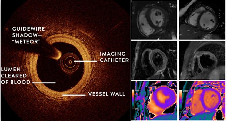 The Women’s Heart Attack Research Program (HARP) study shows combining OCT and cardiac MRI can help detect the underlying cause of heart attacks in women who did not have blocked arteries.