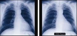 Study Shows Improved Detection of Lung Cancer With CAD Technology
