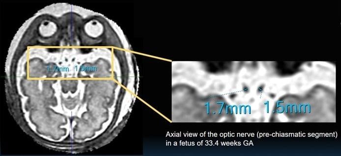 An award-winning Scientific Online Poster presented during the 2023 ARRS Annual Meeting on the island of Oahu explained how the novel technique of three-dimensional (3D) slice-to-volume (SVR) MRI allows for precise delineation and measurement of the fetal optic pathway (FOP). 