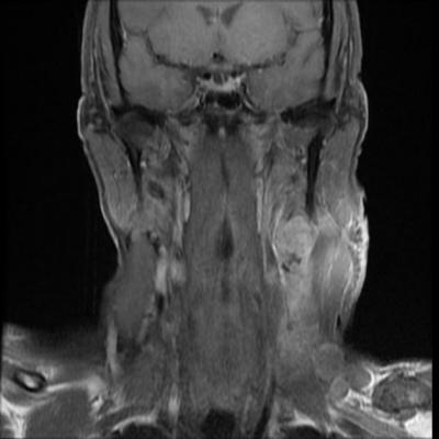 Surgery, Radiation Therapy Equally Effective in Treating Oropharyngeal Cancer