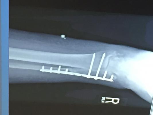 Neiman Health Policy Institute Awarded Grant for Musculoskeletal Clinical Research. Marilyn Fornell