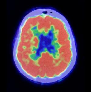 Brain Imaging Study Uncovers Ethnoracial Differences in Dementia 