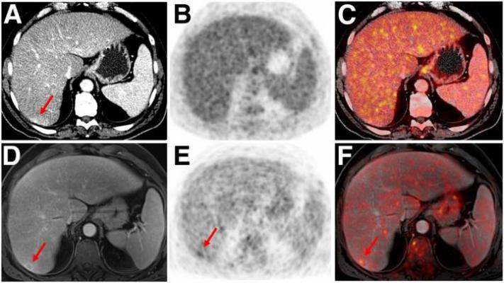 Indeterminate lesion on PET/CT classified by PET/MRI for 53-y-old man with lung cancer. 
