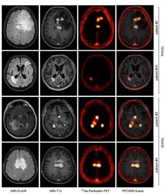 CXCR4-directed PET correlates with MRI-determined lymphoma lesions. Depicted are representative MR images (T1c- and FLAIR- sequences), and the corresponding CXCR4- directed PET images and fusion images (MRI-FLAIR and PET), of two patients with PCNSL and SCNSL, respectively. Images created by Department of Nuclear Medicine, School of Medicine, Technische Universität München, Munich, Germany.