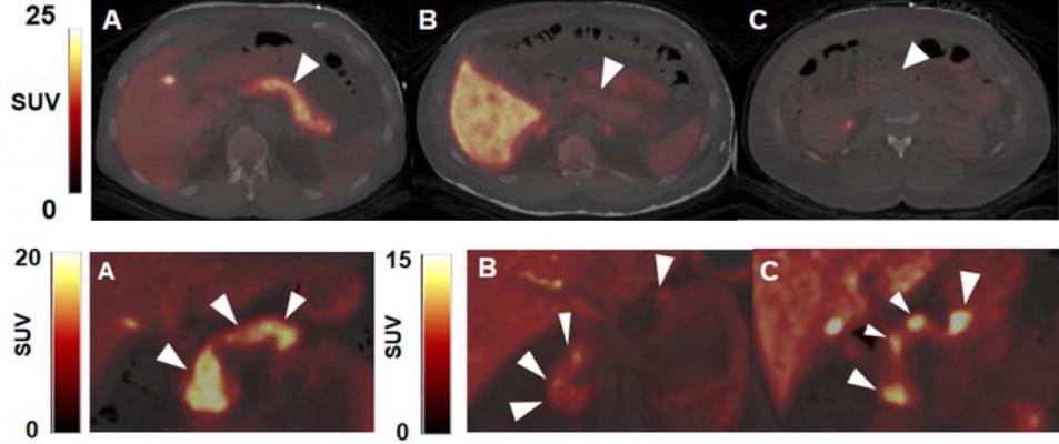 Novel PET Imaging Method Could Track and Guide Type 1 Diabetes Therapy