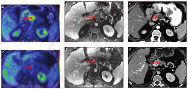 Post-neoadjuvant therapy changes in metabolic metrics from PET/MRI and morphologic metrics from CT were associated with pathologic response and overall survival in patients with pancreatic ductal adenocarcinoma