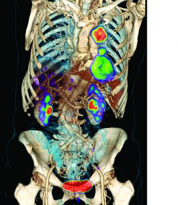 FDG PET/CT, lung cancer, radiation therapy, AJR study, American Journal of Roentgenology