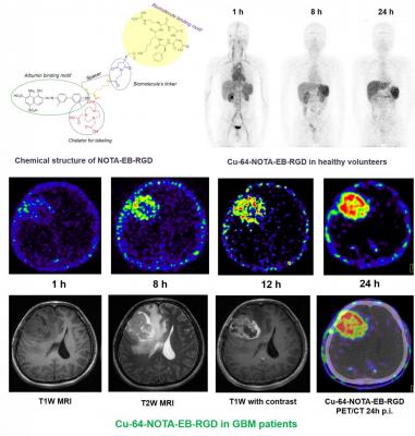 Representative maximum-intensity projection PET images of a healthy human volunteer injected with 64Cu-NOTA-EB-RGD at 1, 8, and 24 hours after injection. Axial MRI and PET slices of glioblastoma patient injected with 64Cu-NOTA-EB-RGD at different time points after injection. Image courtesy of Jingjing Zhang et al., Peking Union Medical College Hospital, Beijing, China/ Xiaoyuan Chen et al., Laboratory of Molecular Imaging and Nanomedicine, NIBIB/NIH, Bethesda, USA