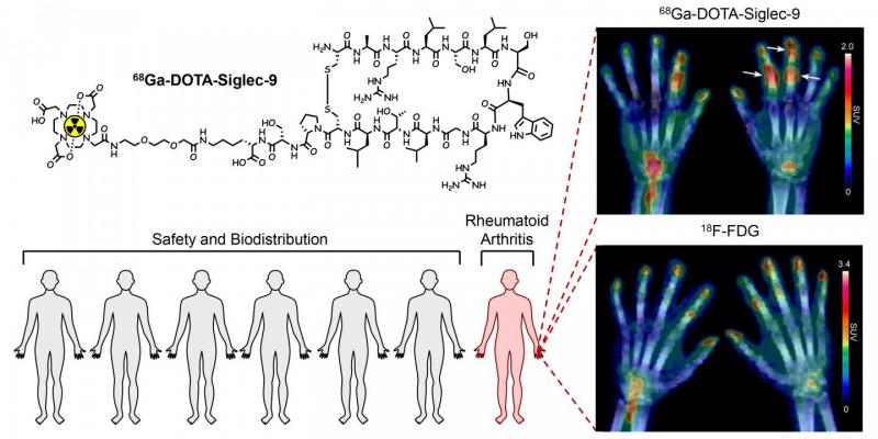 The inflamed joints of a #rheumatoid #arthritis patient are clearly visible in the #PET images with the novel 68Ga-DOTA-Siglec-9 #radiopharmaceutical. Image courtesy of Anne Roivainen