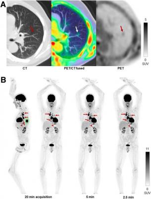 A performance evaluation of the uEXPLORER total-body PET/CT scanner showed that it exhibits ultra-high sensitivity that supports excellent spatial resolution and image quality. Given the long axial field of view (AFOV) of the uEXPLORER, study authors have proposed new, extended measurements for phantoms to characterize total-body PET imaging more appropriately. This research was published in the June issue of The Journal of Nuclear Medicine.