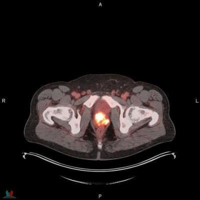 POSLUMA (flotufolastat F 18) PET/CT image showing uptake in the prostate gland, consistent with primary prostate cancer Photo courtesy of Blue Earth Diagnostics 