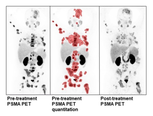 Quantitative analysis of pre-treatment PSMA PET/CT in a patient undergoing treatment with ¹⁷⁷Lutetium-PSMA-617/NOX66. Post-treatment PSMA PET/CT demonstrates reduced tumor volume and PSMA intensity. Images created by S Pathmanandavel and L Emmett, St Vincent's Hospital, Sydney, Australia.