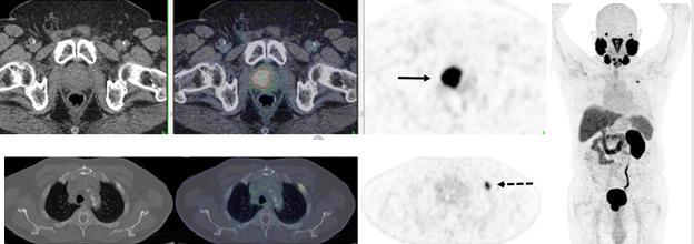 PSMA PET/CT accurately detects recurrent prostate cancer in 67-year-old man. 18F-DCFPyL-PSMA PET/CT shows extensive, intensely PSMA-avid local recurrence in prostate (bottom row; solid arrow) in keeping with the known tumor recurrence in the prostate. Right: PET shows extensive, intensely PSMA-avid local recurrence in prostate (top row; solid arrow) and a solitary bone metastasis in left rib 2 (bottom row; dotted arrow). Image courtesy of Ur Metser, et al.