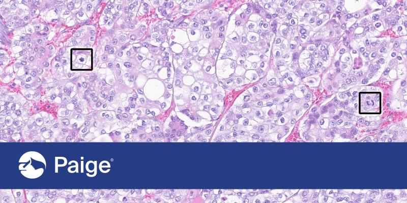 Paige’s robust suite of AI-powered applications delivers greater accuracy, confidence and efficiency for breast cancer diagnosis and reduces the burden of manual diagnosis 