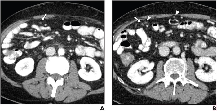 66-Year-Old Man With Locally Advanced Pancreatic Cancer Undergoing Chemotherapy
