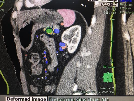 New Guideline Clarifies Role of Radiation Therapy in Pancreatic Cancer Treatment