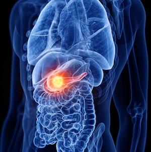 Updated Guideline on Radiation Therapy for Pancreatic Cancer Now Available