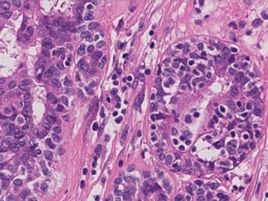 New Pathology Guideline Advances Accuracy in Breast Cancer Testing