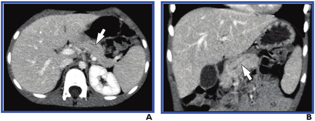 (A) Axial and (B) coronal reformatted images from CT performed with IV contrast material show segmental visualization of main pancreatic duct (arrow). One of three reviewers described main duct dilation as present. Agreement among reviewers on CT for main duct dilatation was substantial (κ=0.63).