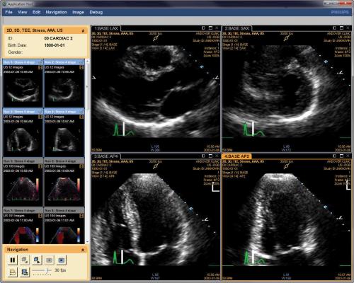 Cardiac Imaging Reveals Roots of Preeclampsia Damage in Pregnant Women