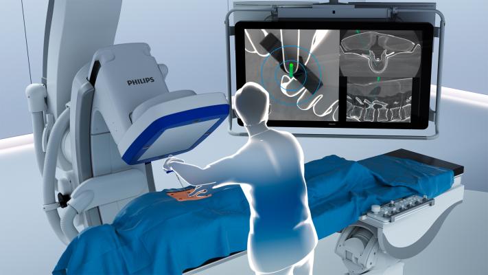 For both cases the surgeons used Philips integrated Spine Suite solution that offers the company’s Azurion Hybrid Operating Room (OR) with ClarifEye, an industry-first solution that combines 2D and 3D visualizations at low X-ray dose with 3D AR navigation into one system. 