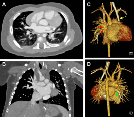 Cardiac photon-counting CT (PCCT) in a 174-day-old male infant with complex congenital heart defect. 