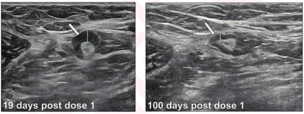 Lymph node measurements in 33-year-old woman for bilateral screening breast ultrasound. 